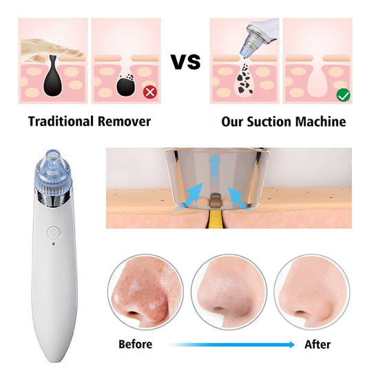 Rechargeable 4-in-1 Blackhead Removal Device